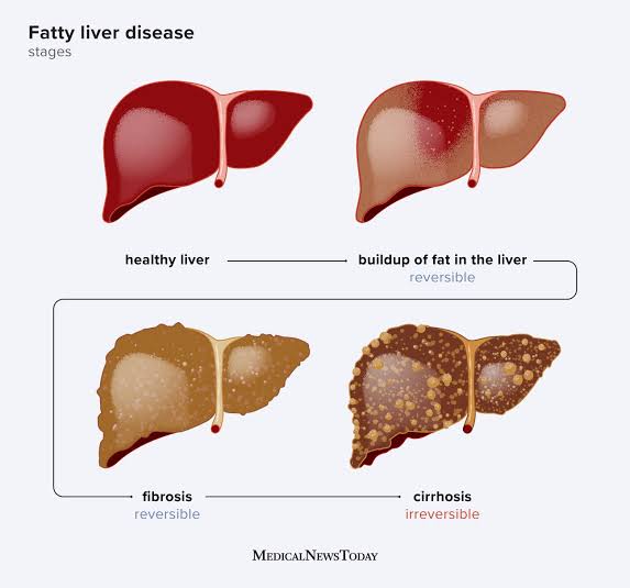 Fatty Liver: Causes, Symptoms, and Treatment